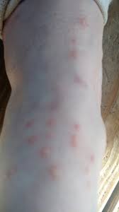 Chiggers Turkey Mites Sufficientself Creating A Sustainable Lifestyle