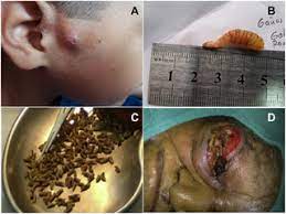 Hewan berdarah panas termasuk manusia. Human Myiasis In Ecuador