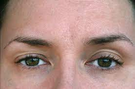 About 17,016 results (0.53 seconds). Eyelid Disorders Boca Raton Eyelid Surgery Delray Beach