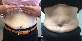 Considering the healing time and cosmetic concerns of patients, over time, gastric bypass surgery has evolved into newer procedures. Minimally Invasive Sleeve Gastrectomy