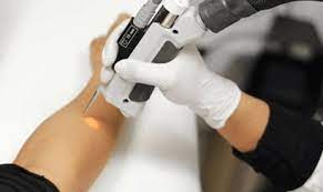 Why the best time for laser hair removal is now cynosure hair removal. Laser Hair Removal Elite Allure Skin Laser Clinic