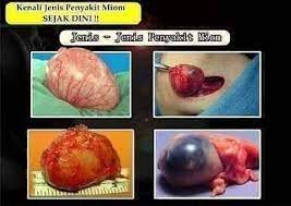 Miom Adalah Tumor Jinak Yang Berbentuk Daging Yang Tumbuh Di Rahim Sebagian Kecil Miom Ini Tumbuh Di Lehe Fruit Wedding Diy Table Decor Rustic Country Wedding