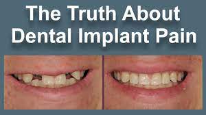 In my more than a decade of placing dental implants, most of my patients say, that was much easier than i thought! Are Dental Implants Painful Youtube