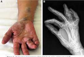 Pdf Maffucci Syndrome Associated With Adrenocorticotropic Hormone Independent Bilateral Macronodular Adrenal Hyperplasia Semantic Scholar