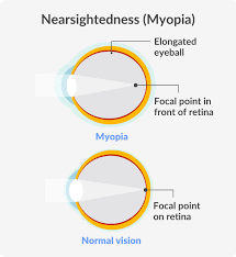 Image result for Myopia