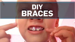 The fake braces took about 45 minutes. Orthodontists Warn Against Homemade Braces Ctv News