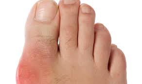 Sesiapa yang ada gout, mencari penawar paling mujarab, boleh. Gout Could Be Genetic Express Co Uk
