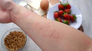 Image result for Hives