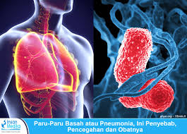 Secara ringkasnya, amalan gaya hidup sihat adalah kunci kepada kesihatan yang baik. Paru Paru Basah Pneumonia Penyebab Jenis Gejala Dan Pengobatan