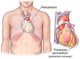 Both are caused by a viral infection, although other infections can also lead to an inflammation of the heart. Pericarditis Symptoms Causes Treatments