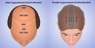 This can be an advantage if the person only requires a few grafts, as it may oral finasteride (propecia): Hair Restoration Cost Michigan Ann Arbor Plastic Surgery