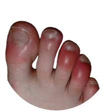 Image result for Chilblains