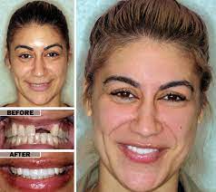 Maybe you would like to learn more about one of these? Dental Implants Vs Dentures Brooklyn Implant Dentist