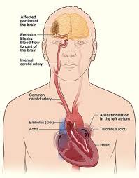 Image result for Atrial Fibrillation