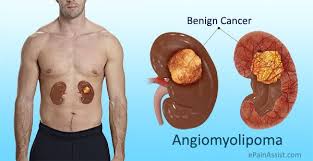 Changes In Kidney Structure Caused By Angiomyolipoma Liver Detox Symptoms Tuberous Sclerosis Kidney Tumor