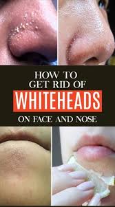 How To Get Rid Of Whiteheads On Nose And Face How To Get Rid Whiteheads Treating Dry Skin