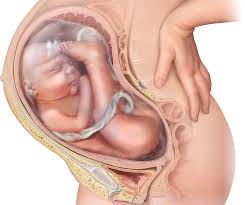 Image result for Breech Delivery