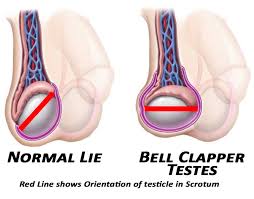 Both surgery and hormone treatment can have untoward effects. Bell Clapper Testes Mr Andrew Robb