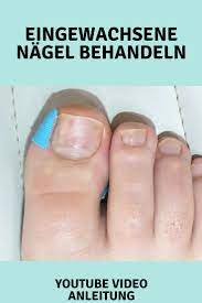 eingewachsene nagel konnen mit hilfe eines nagelfalztapes behandelt werden hier kommst du zur video anleitung eingewachsener nagel zehennagel nagel
