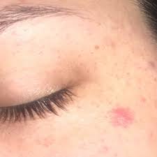 Have you noticed red dots suddenly appearing on your skin? Not A Super Gross Tmi Or Anything But My Boyfriend And I Had Sex And Before My Skin Was Clear Afterwards I Had All Of These Tiny Red Dots Mainly Around My