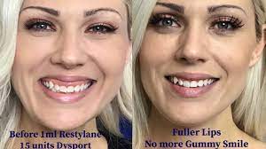 We did not find results for: How To Reduce A Gummy Smile Youtube