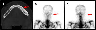Image result for Osteomyelitis Bone Scan