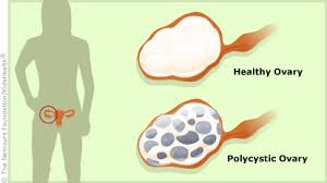 Polycystic Ovary Syndrome
