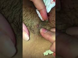 An ingrown hair that appear in your armpit can be painful with a lot of problems. Ingrown Hairs In Armpit Youtube