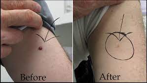 Cherry angiomas, also known as campbell de morgan spots or senile angiomas, are cherry red papules on the skin. Cherry Angiomas Solutions Medical Center Medical Services Collerville Tn