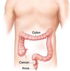 7 signs of colon cancer you should never ignore. Ribbon Stools Caused By Ibs Vs By Colon Cancer Comparison Scary Symptoms