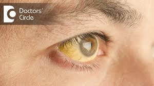 These three aspects are the main fields for preventional int … Symptoms Complications Of Hepatitis B Can Hepatitis B Be Cured Dr Ramakrishna Prasad Youtube
