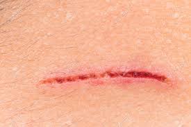 The leftmost interval corresponds to level one, the next leftmost to level two and so on. Deep Painful Cut On The Forehead Stock Photo Picture And Royalty Free Image Image 41122911