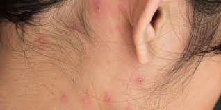 Seperti apa ya cara merawat lovebird yang tepat agar cepat ngekek? Cara Merawat Chicken Pox Dengan Cepat Biaya Pendidikan