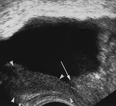 Noticias sobre descargar el libertino invisible. Local Recurrence After Radical Prostatectomy Correlation Of Us Features With Prostatic Fossa Biopsy Findings Radiology