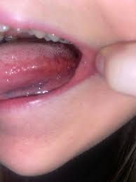 Image result for Puchýře na jazyku