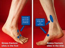 This fracture walking boot is a quality boot at a good price. Stress Fractures Diagnosis And Recovery Realbuzz Com
