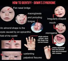 It may also be called trisomy 21; Facebook