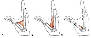 Reconstruction Of First Web Space Contractures Semantic Scholar