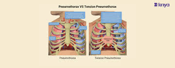 Image result for Open Pneumothorax