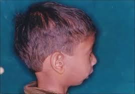 Pierre-Robinův syndrom, sekvence