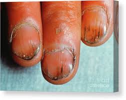 Image result for Koilonychia feet