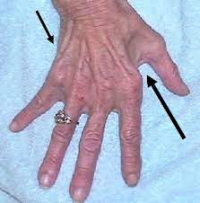 Cubital Tunnel Syndrome