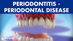 But most people don't know that they have it. Gum Disease Periodontitis Periodontal Disease C Youtube