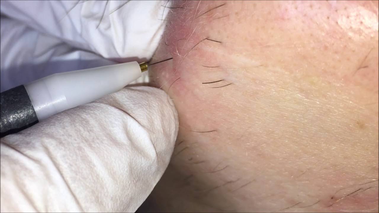Electrolysis- permanent hair removal product image