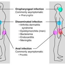 Image result for gonorrhea symptoms