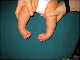 If someone has a club foot , they are born with a badly twisted foot. Manipulation And Brace Fixing For The Treatment Of Congenital Clubfoot In Newborns And Infants Bmc Musculoskeletal Disorders Full Text