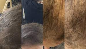 If it happens, you'll usually notice it within the first 2 weeks of treatment. Hair Growth After Lymphoma Treatment