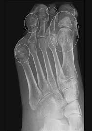 Image result for Osteomyelitis XRay