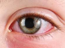 In some cases, keratitis can affect your vision. Keratitis