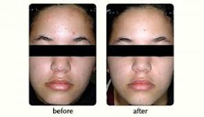 Photodynamic Therapy Blue Light Blu U Sun Spots Acne Actinic Keratoses Aks Skin Rejuvenation